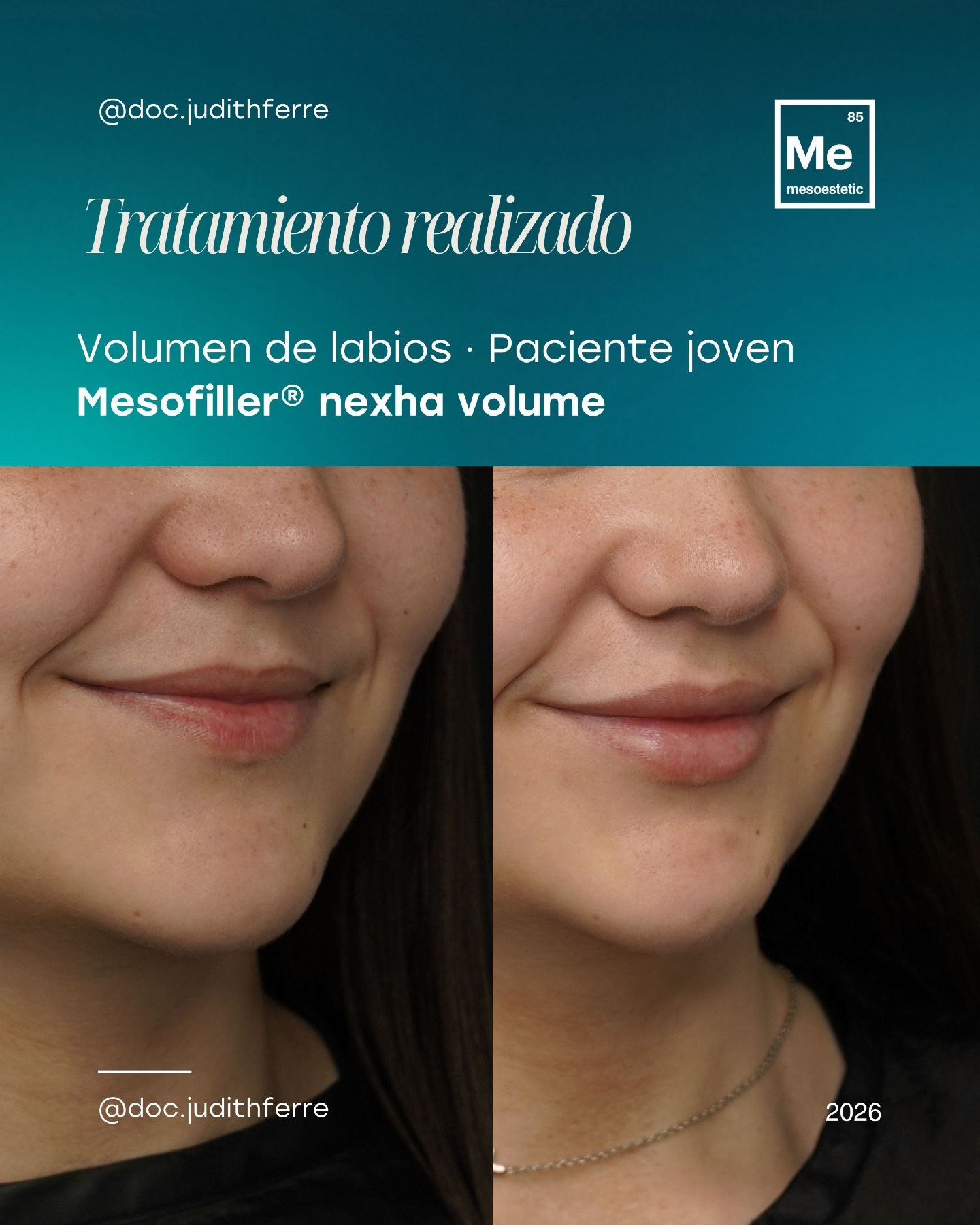 Lip volume treatment result by Dra. Judith Ferré