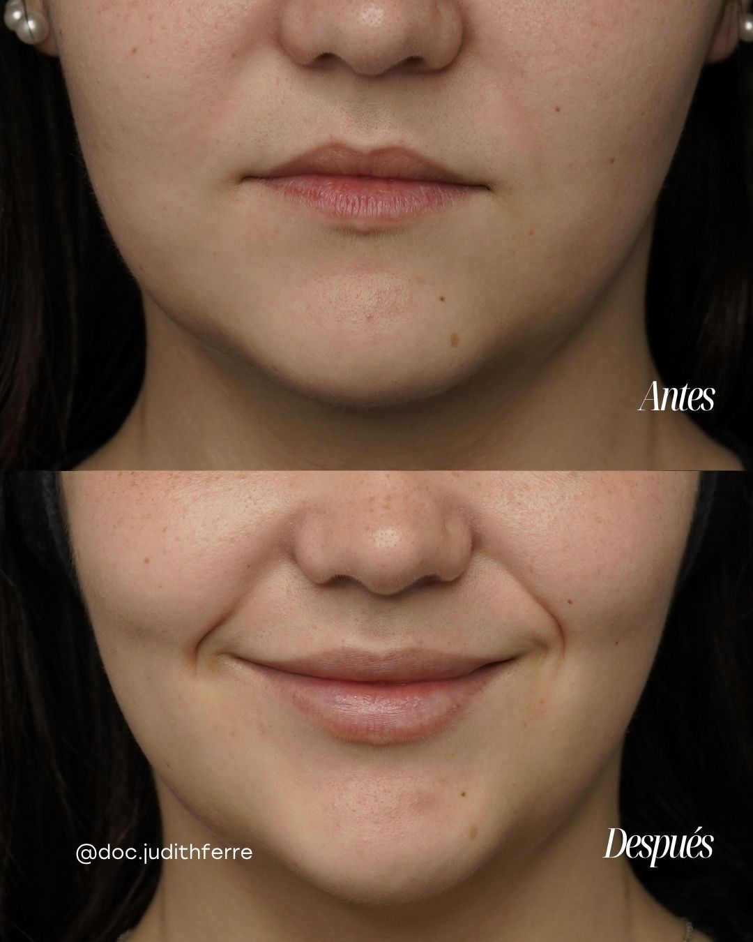 Before and after lip treatment, frontal view