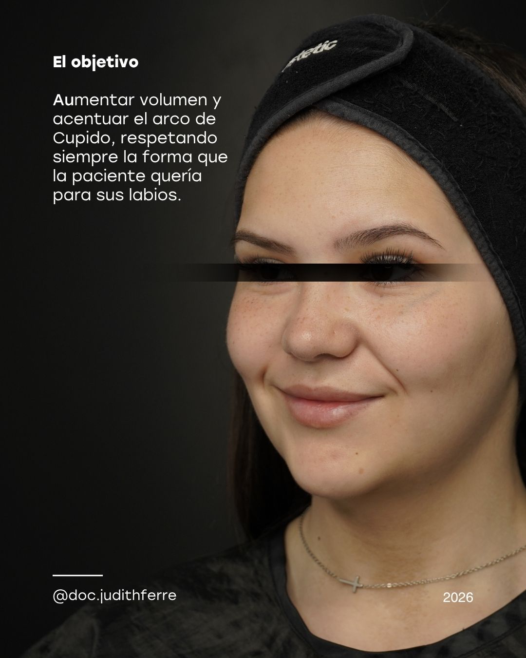 Treatment objective: natural volume and cupid bow definition