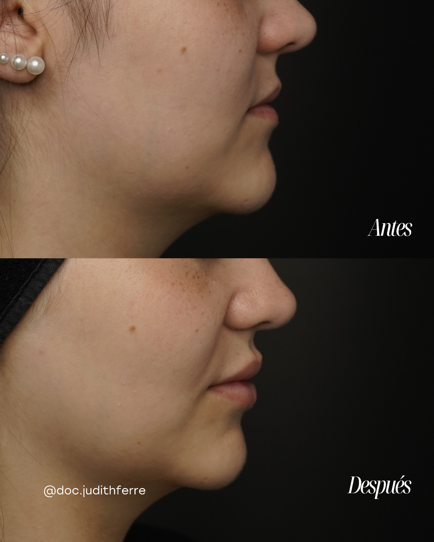 Before and after lip treatment, right profile