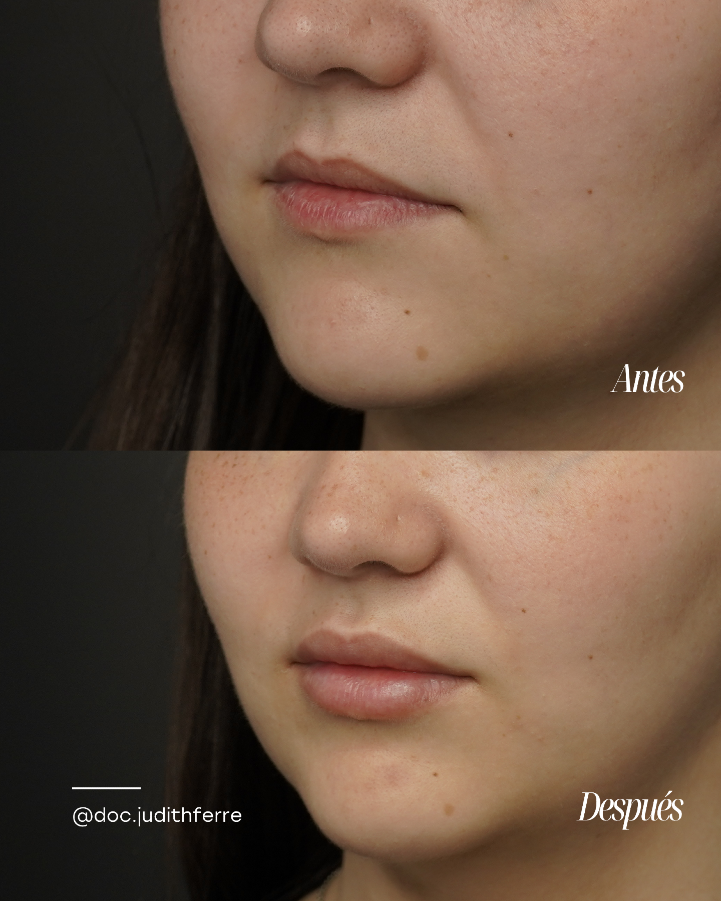 Before and after lip treatment, three-quarter view