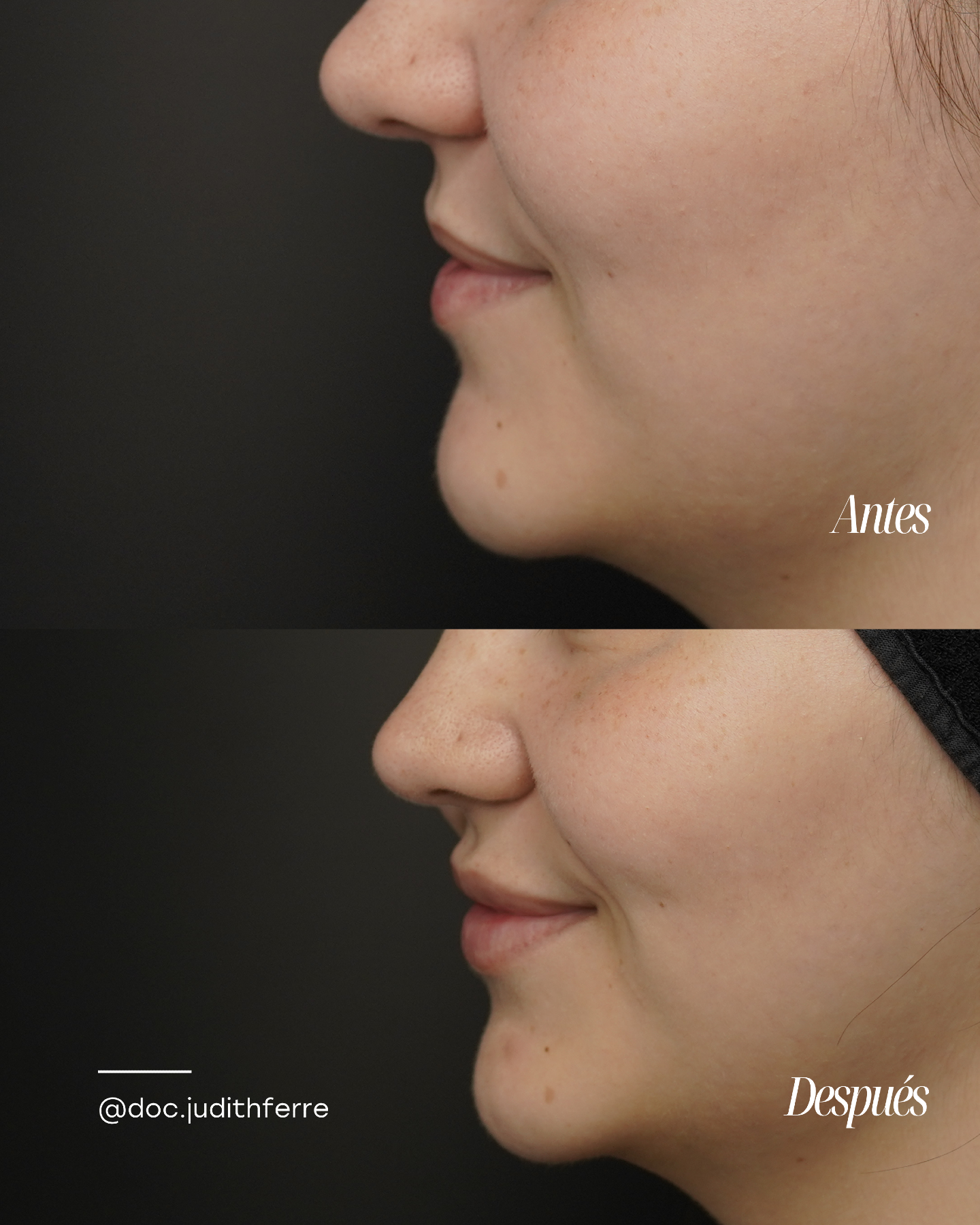 Before and after lip treatment, left profile